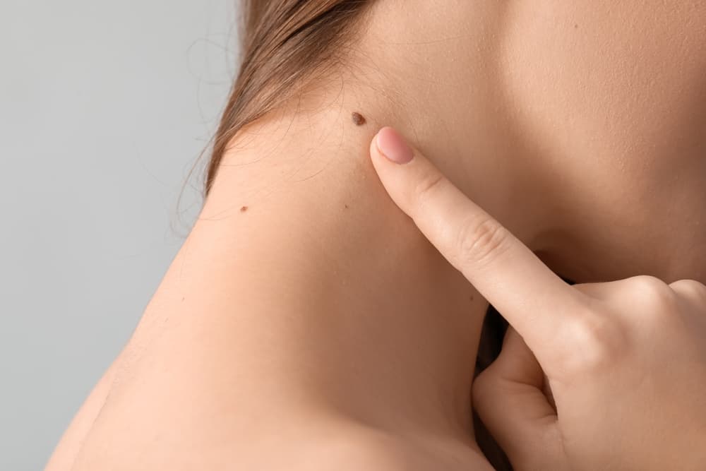 Is That Mole a Lucky Sign? Discover the Hidden Astrological Meaning